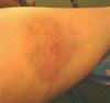 Internal lesions from mold exposure (non injury bruising) size of softball