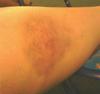 Internal lesions from mold exposure (non injury bruising) size of softball